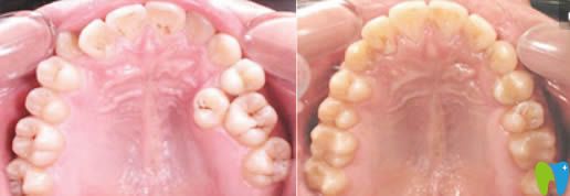  南京佑德口腔傅進(jìn)友主任牙齒正畸效果圖