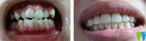 武漢壹加壹口腔成人隱形矯正前后對(duì)比照