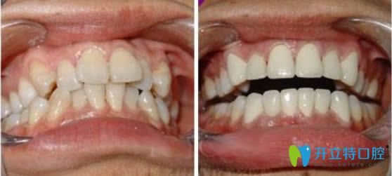 成人牙齒擁擠矯正前后對(duì)比照