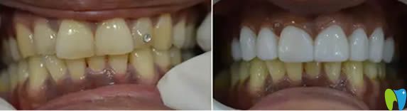 武漢壹加壹口腔牙齒冷光美白對(duì)比效果