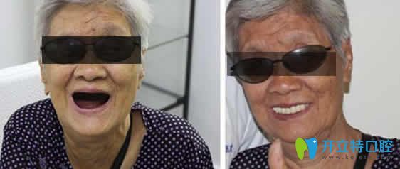 天津德倍爾口腔張振生全口種植牙案例效果圖 天津德倍爾口腔張振生全口種植牙案例效果圖