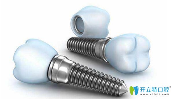 種植體品牌對種植牙價(jià)格有直接影響