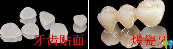 烤瓷牙好還是牙齒貼面好，區(qū)別是什么？具體答案都在這里