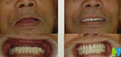 寧波協(xié)禾口腔王昭文院長(zhǎng)全口牙種植案例效果
