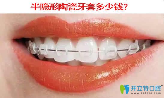 半隱形陶瓷牙套多少錢(qián)？本文提供陶瓷托槽牙齒矯正價(jià)格表