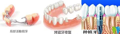種植牙、活動假牙和烤瓷牙哪個好？看完你就會明白哦