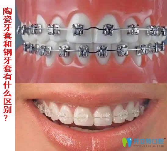 陶瓷牙套和鋼牙套有什么區(qū)別