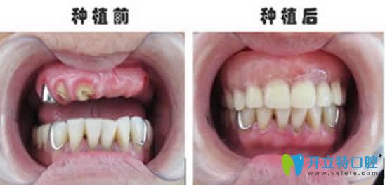 寧波協(xié)禾口腔王昭文院長種植牙案例效果圖 寧波協(xié)禾口腔王昭文院長種植牙案例效果圖