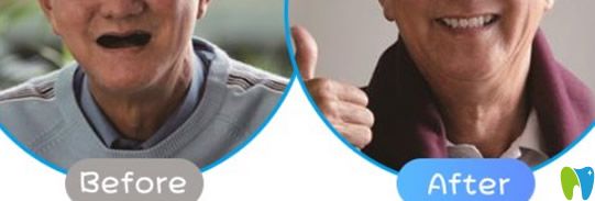 牙博士口腔全口牙種植案例效果對(duì)比