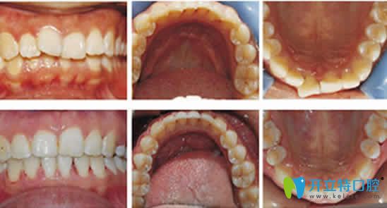 寧波協(xié)禾口腔牙齒矯正前后對比圖 寧波協(xié)禾口腔牙齒矯正前后對比圖
