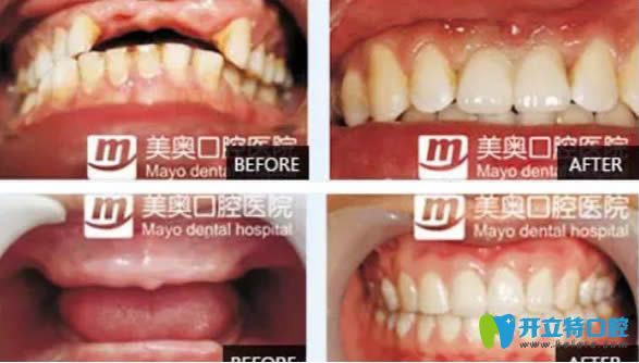 天津美奧口腔種植牙真實(shí)案例