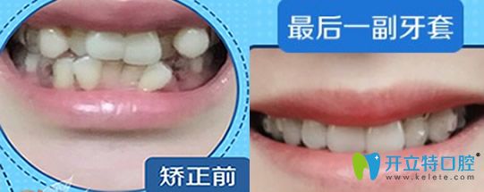 屬于泉州牙博士口腔牙齒過(guò)度擁擠不齊矯正案例對(duì)比圖