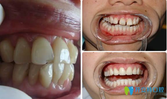 天津美奧隱形牙齒矯正前后對(duì)比照