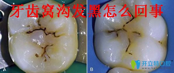 牙齒窩溝黑線怎樣能去除 光固化樹(shù)脂補(bǔ)牙縫及補(bǔ)牙價(jià)格分享