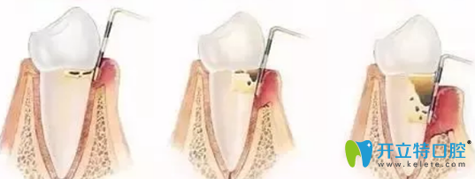 牙齦炎和牙周炎該如何治療呢