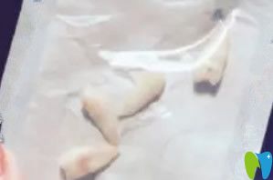 在武漢萌芽齒科較正時(shí)拔掉的牙齒 在武漢萌芽齒科較正時(shí)拔掉的牙齒