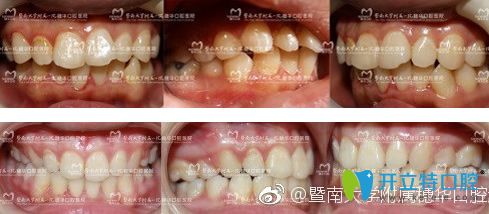 廣州穗華口腔隱形牙齒矯正對比圖