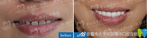 廣州穗華口腔瓷貼面療效圖