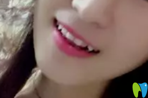 去武漢萌芽齒科矯正牙齒前 去武漢萌芽齒科矯正牙齒前