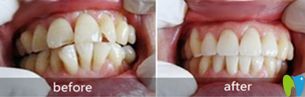 蘇州拜博口腔正畸好嗎？齙牙+牙齒擁擠不齊矯正案例來(lái)驗(yàn)證