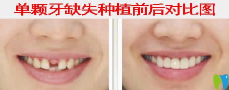 南昌輝煌口腔白彭院長種植牙案例效果圖