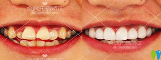 <!--<i data=20240703-sp></i>-->美萊口腔靠譜嗎？真人案例效果來(lái)驗(yàn)證實(shí)力