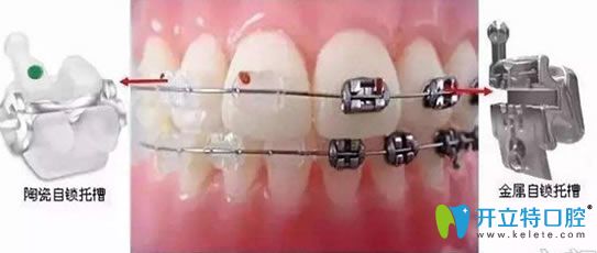 陶瓷托槽和金屬托槽區(qū)別圖示