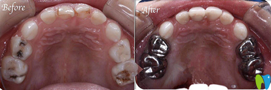 瑾帆口腔兒童舒適化治療齲齒案例