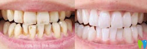 開立特口腔牙齒冷光美白效果對(duì)比圖