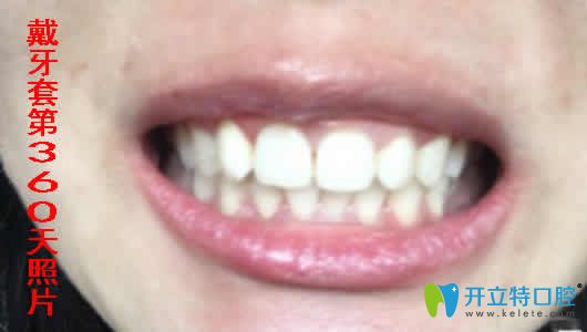 我在合肥世佳口腔做牙齒矯正一年的照片 我在合肥世佳口腔做牙齒矯正一年的照片