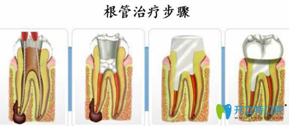 智麗媛醫(yī)生解答什么情況需要根管治療 智麗媛醫(yī)生解答什么情況需要根管治療