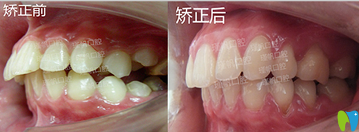 桂林瑾帆口腔好不好？真人牙齒矯正案例及術(shù)后反饋來(lái)驗(yàn)證