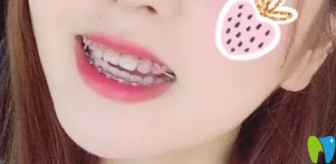 武漢斯美爾口腔矯正第200天效果圖 武漢斯美爾口腔矯正第200天效果圖