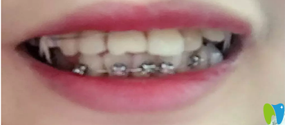 在武漢斯美爾口腔矯正天 在武漢斯美爾口腔矯正天