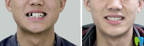 優(yōu)植口腔王順正醫(yī)生種植牙對比圖