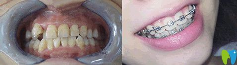 北京誠之康口腔正畸怎么樣？來看對比圖
