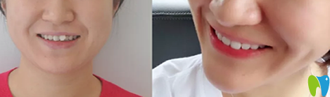 在優(yōu)植口腔牙齒矯正對比圖