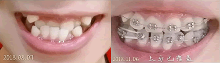 誠(chéng)之康口腔周春醫(yī)生做牙齒矯正的三個(gè)月對(duì)比圖 誠(chéng)之康口腔周春醫(yī)生做牙齒矯正的三個(gè)月對(duì)比圖