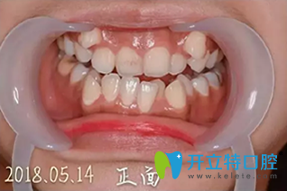 我在誠(chéng)之康口腔矯正前照片 我在誠(chéng)之康口腔矯正前照片