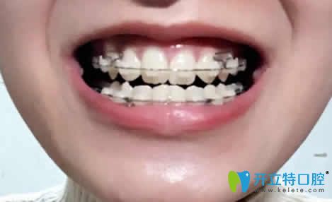 我在廈門天使口腔做虎牙矯正12個月照片