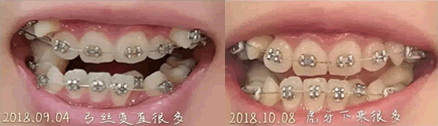 我在誠(chéng)之康口腔牙齒矯正一個(gè)月效果圖 我在誠(chéng)之康口腔牙齒矯正一個(gè)月效果圖