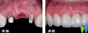 北京誠之康口腔種植牙前后對比圖