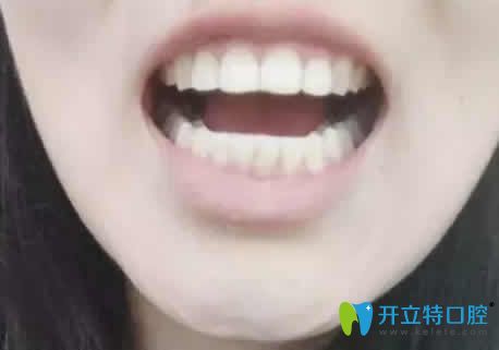 我在廣州偉聯(lián)口腔做正畸14個月效果 我在廣州偉聯(lián)口腔做正畸14個月效果