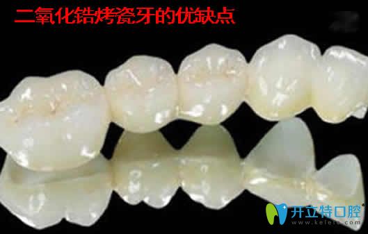 二氧化鋯烤瓷牙的優(yōu)缺點