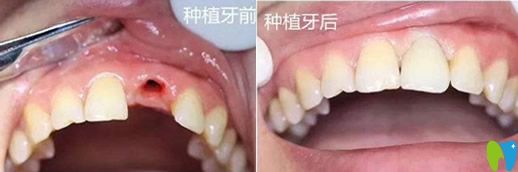 未來口腔歐陽秋單顆牙種植實(shí)例療效對(duì)比圖