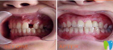 協(xié)合口腔陽望春種植牙效果圖