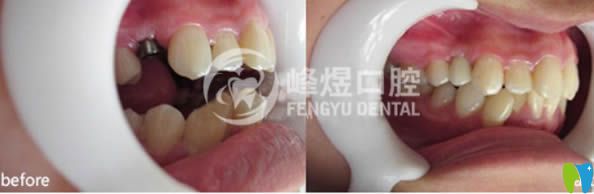 廈門峰煜口腔單顆牙缺失種植案例