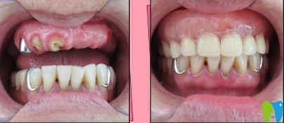 桂林瑾帆口腔李冉洲怎么樣呢？真人種植牙案例來驗證