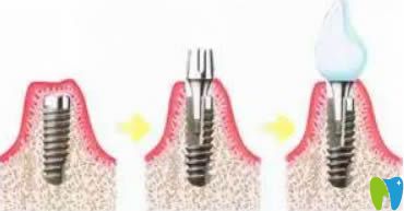 杭州植得口腔種植牙