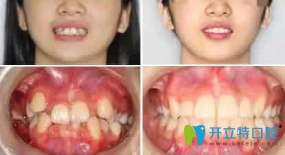 湛江致美口腔梁陳生牙齒擁擠矯正案例效果圖 湛江致美口腔梁陳生牙齒擁擠矯正案例效果圖